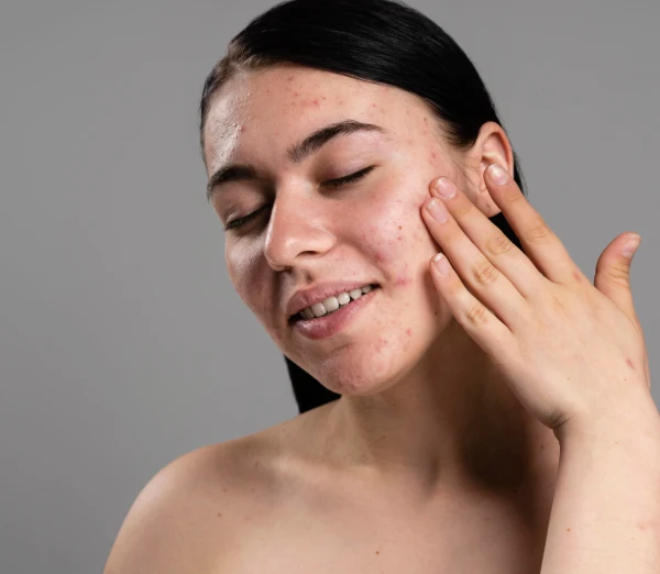 Acne Scar Treatment Acne Scar Treatment