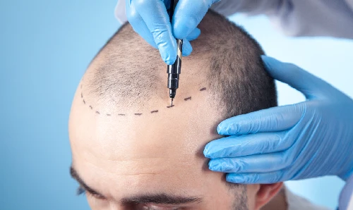 HNon-Surgical Hair Replacement HNon-Surgical Hair Replacement