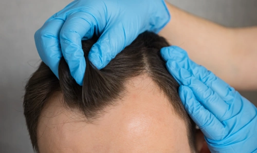 Hair Transplant (FUE & FUT) Hair Transplant (FUE & FUT)