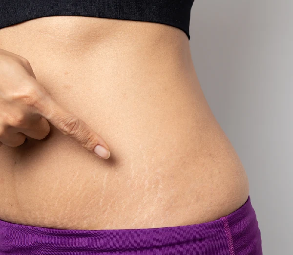 Stretch Marks Reduction Stretch Marks Reduction