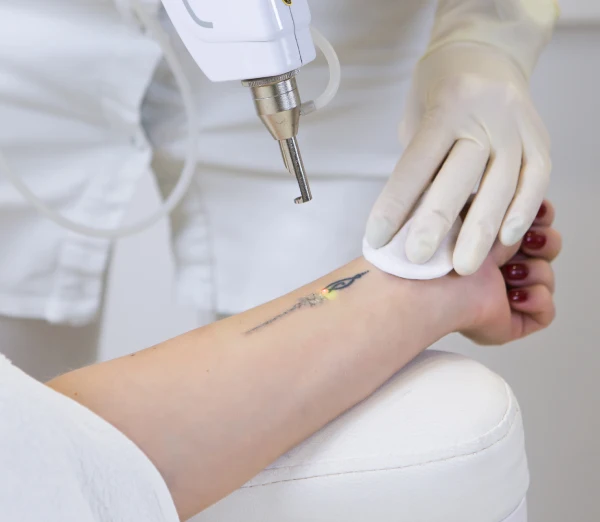 Tattoo Removal Tattoo Removal
